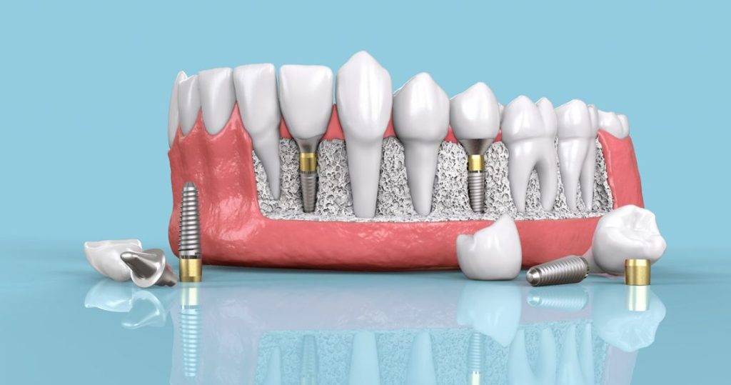 dental implants in Maryland