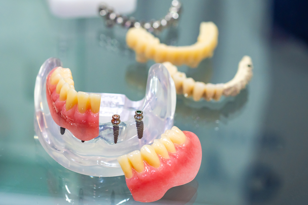 model of mini implant
