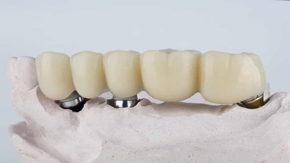 model of an implant bridge